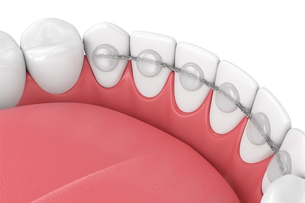 Fixed retainer wire bonded behind the lower front teeth